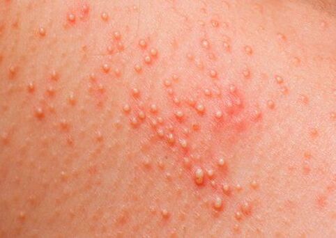 If the body is affected by parasites, a skin allergy occurs
