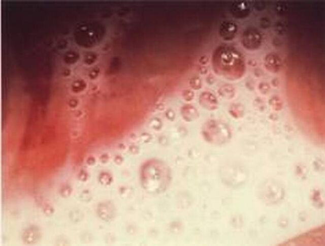 bladder discharge with protozoan parasites
