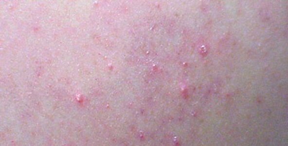 A rash on the body can be a sign of helminthosis